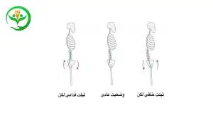 ناهنجاریهای اسکلتی در کاربران ویلچر